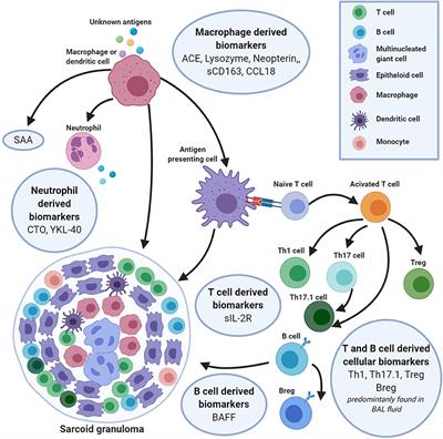 Biomarkers in the Diagnosis and Prognosis of Sarcoidosis: Current Use and Future Prospects